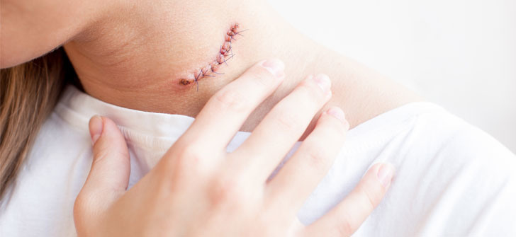 Татуаж шрамов